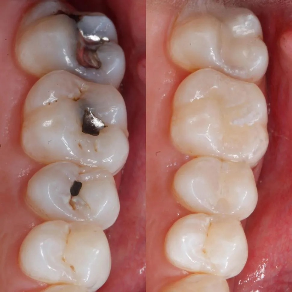 Discolored Tooth Filling, Annapolis Specialist for Restoring Your Dental  Aesthetics